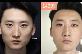 术中好可怕？100秒“揭秘”歪鼻+鼻中隔偏曲矫正“全过程”！视频封面