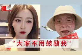 四川烧伤女孩经历12次手术重生，开直播透露近况：请把我当正常人视频封面