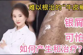 银屑病 俗称难以根治的牛皮癣 如何产生和治疗？看完收藏视频封面