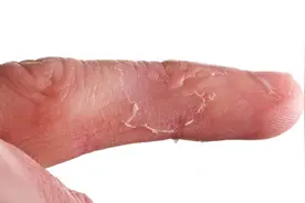手上长透明小水泡？又痒又痛，或是身体发出的警报信号！视频封面