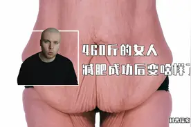 460斤胖子减肥成功，2年甩掉320斤肉！却在肚子上留在一块赘皮？视频封面