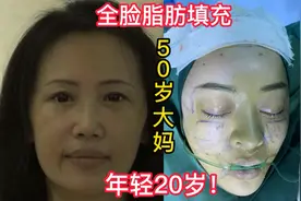 50岁大妈面部凹陷，显老态，做全脸脂肪填充手术后，年轻20岁！视频封面