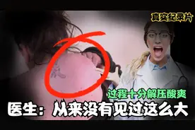 医生直呼：从来没有见过这么大的脂肪瘤！切除过程十分解压酸爽视频封面