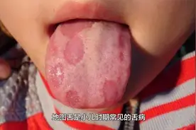小儿地图舌的辨证论治视频封面