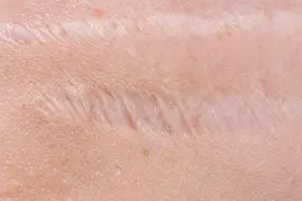 手术缝针的疤痕怎么消除？皮肤科大夫告诉你，如何解决视频封面