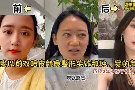 我之前双眼皮就像整形失败宽的夸张，历经2年多终于修复上岸了！视频封面