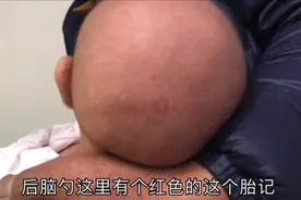 新生儿头上有一块红色的胎记 算命先生说这是好兆头 会消失吗视频封面