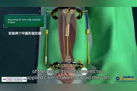 胫骨粉碎性骨折治疗方法-骨搬运技术