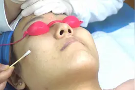 激光点阵剥脱去痘坑痘印vlog，医美恢复期记录视频封面