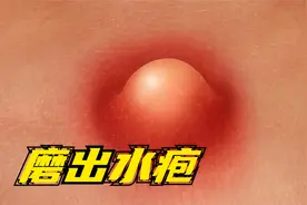 脚上磨起了泡怎么办？要不要挑破?