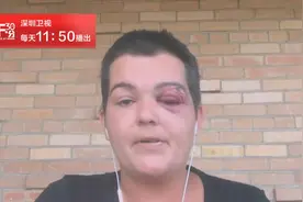 美国女记者被警察用子弹击中眼睛 致左眼永久失明