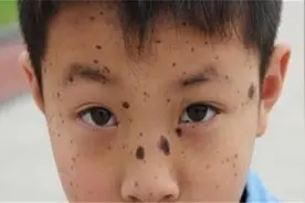 脸上黑痣好难看，一根胡萝卜来帮忙，淡化黑痣更显年轻白净视频封面