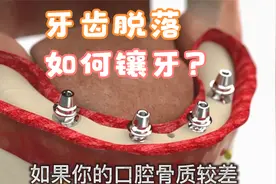全口牙齿缺失的种植技术有哪些方法？立马分享给爸妈，看完秒懂
