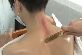 广东七旬老伯自行刮痧进了ICU，医生紧急提醒视频封面
