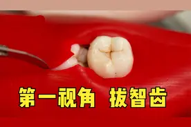 第一视角拔智齿，手术刀切开牙龈，电钻将牙齿一分为二，看着真爽