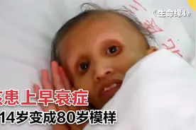 女孩4岁患上早衰在，14岁时变成80岁模样，医生毫无办法视频封面