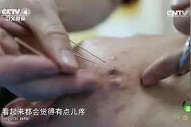 针灸治痘需要在脸上扎针？疗法恐怖吓退女孩，听听中医的详细解释视频封面