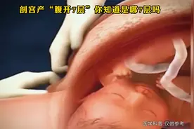 剖宫产“腹开7层”，但你知道是哪7层吗？生孩子是很不容易的