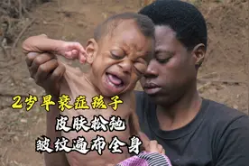 早衰症孩子降临，家庭的破灭，年轻母亲的悲惨遭遇，真因为孩子？视频封面