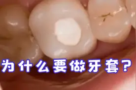 根管治疗以后为什么要做冠修复起来，牙套是保护牙齿的，需要做！视频封面