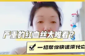 红血丝严重太难看怎么办？一招帮你快速改善大红脸，简单又省钱