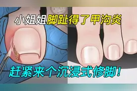 小姐姐常年穿高跟鞋，趾甲得了甲沟炎和鸡眼！赶紧请出顶级修脚师视频封面