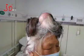 头顶长“犄角” 患者受不了视频封面