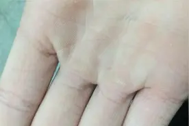 手上起老茧，教你一个好方法，轻松去除