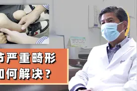 13岁关节严重畸形，10年无法正常行走！骨科医生给出方案解难题视频封面