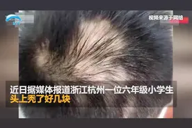 12岁男孩脱发头顶秃了好几块 医生：学习压力过大长期熬夜导致视频封面