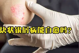 医生讲解：斑块状银屑病能自愈吗？治疗药物如何选择？视频封面