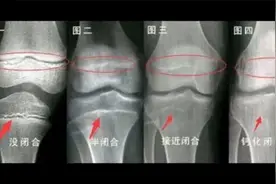 骨骺线闭合的判断