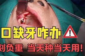 全口缺失牙怎么办？即刻负重种植修复来搞定！视频封面