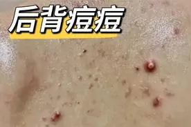 21天解决频繁爆发的螨虫痘痘！试过的人都成功了！