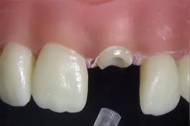 牙齿烂得只剩根部了也能挽救——打桩过程展示