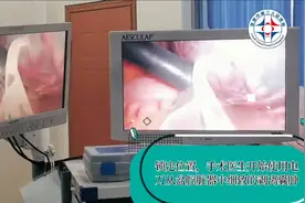 腹腔镜下卵巢囊肿切除全过程（22）视频封面