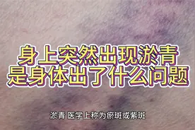 身上突然出现淤青，是身体出了什么问题？这几种疾病可能与之相关视频封面
