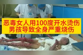 恶毒女人用100度开水烫伤男孩，导致全身严重烧伤