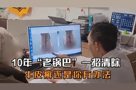 大姐身上10年“老锅巴”一招清除，高兴万分：牛皮癣还是你有办法视频封面
