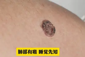 肺部有癌，睡觉先知，睡觉时出现这5个异常，要引起警惕！视频封面