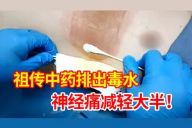 复诊实录：中药治带状疱疹后遗神经痛，精准排出毒素，从根上止痛视频封面