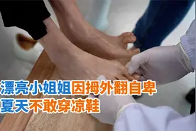 漂亮小姐姐因拇外翻自卑，夏天不敢穿凉鞋视频封面