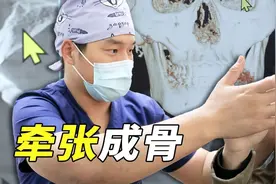 面诊遇见“凹凸Man”-面中凹陷 牙槽骨前突