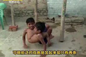 3.连体双胞胎共用两条腿，很好奇究竟是哪个大脑控制双腿行动呢？