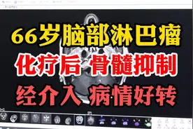 66岁脑部弥漫大B细胞淋巴瘤，化疗出现骨髓抑制，做介入情况好转视频封面