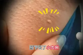 腋下长了“小肉揪”，是不是得了什么脏病？？视频封面