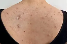 3年后背痘痘这么简单就好了！这个方法值得学习！