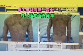 男子后背爬满“蠓虫”？晚上睡觉直蹭床单！医生解释：点状银屑病视频封面