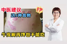 这5种食物，牛皮癣再馋也不能吃，中医建议视频封面