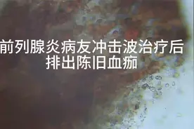 前列腺炎病友冲击波治疗后排出陈旧血痂视频封面